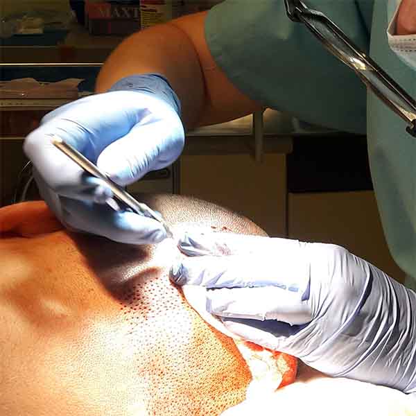 FUE TRANSPLANTACIJA KOSE